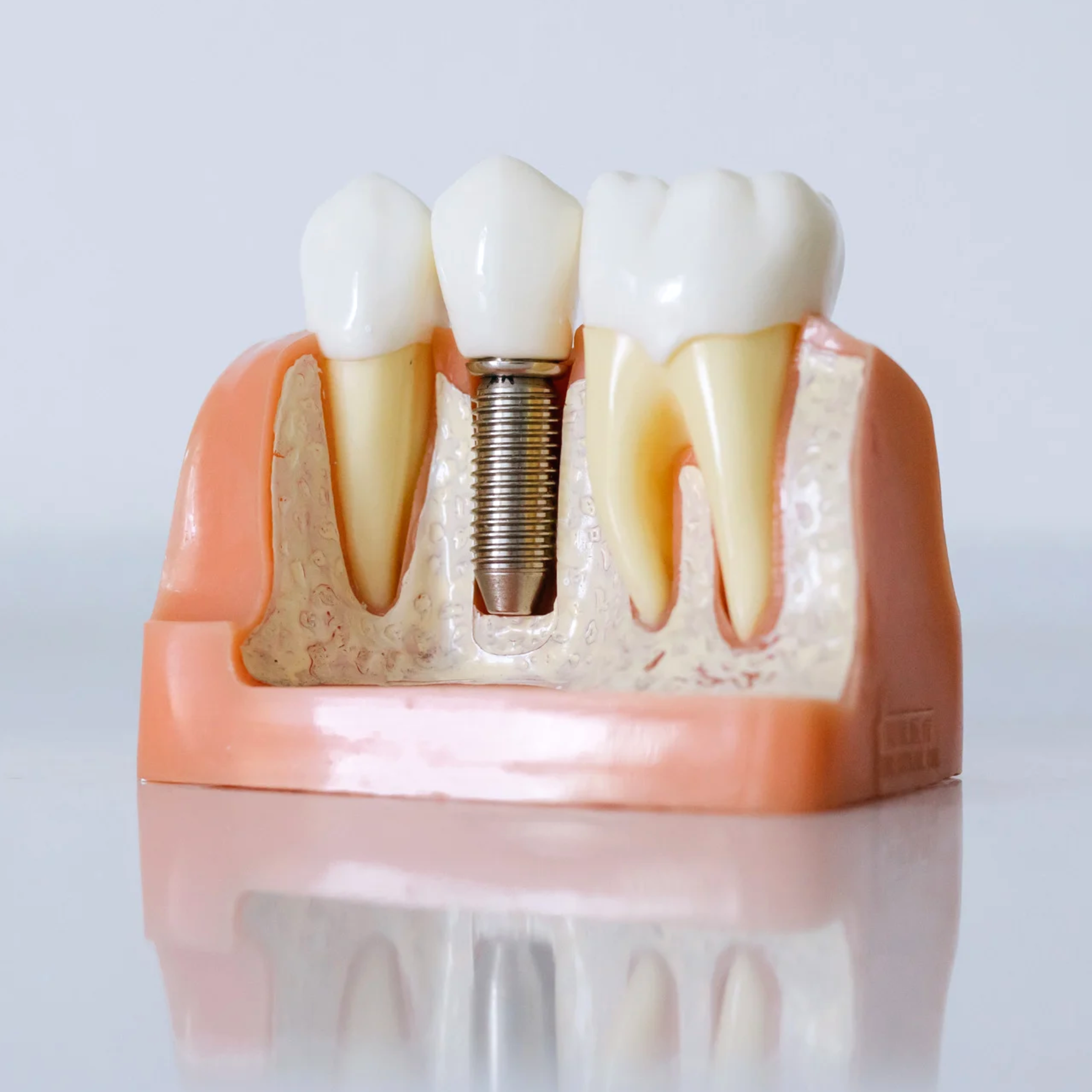 Implantes